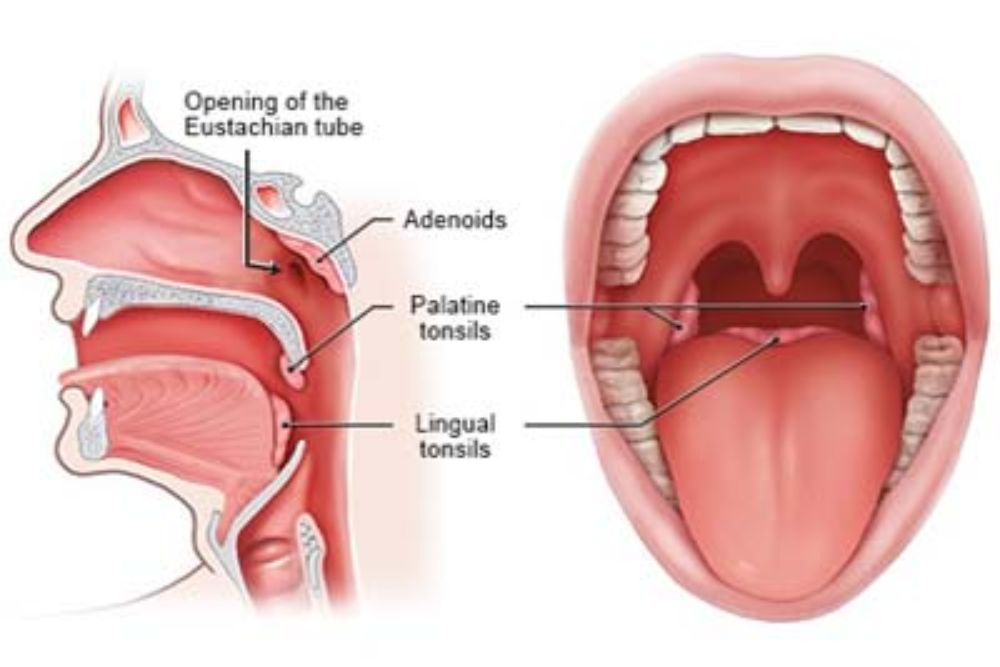 Coblation-Assisted Tonsillectomy and Adenoid Surgeries