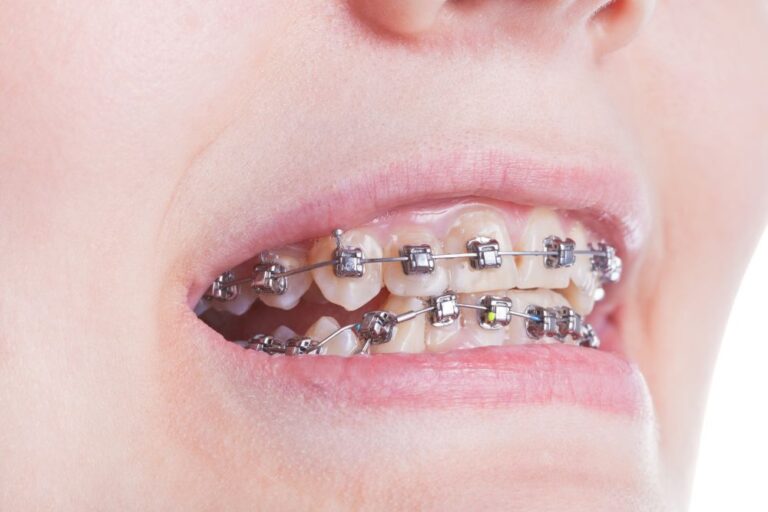 Orthodontic