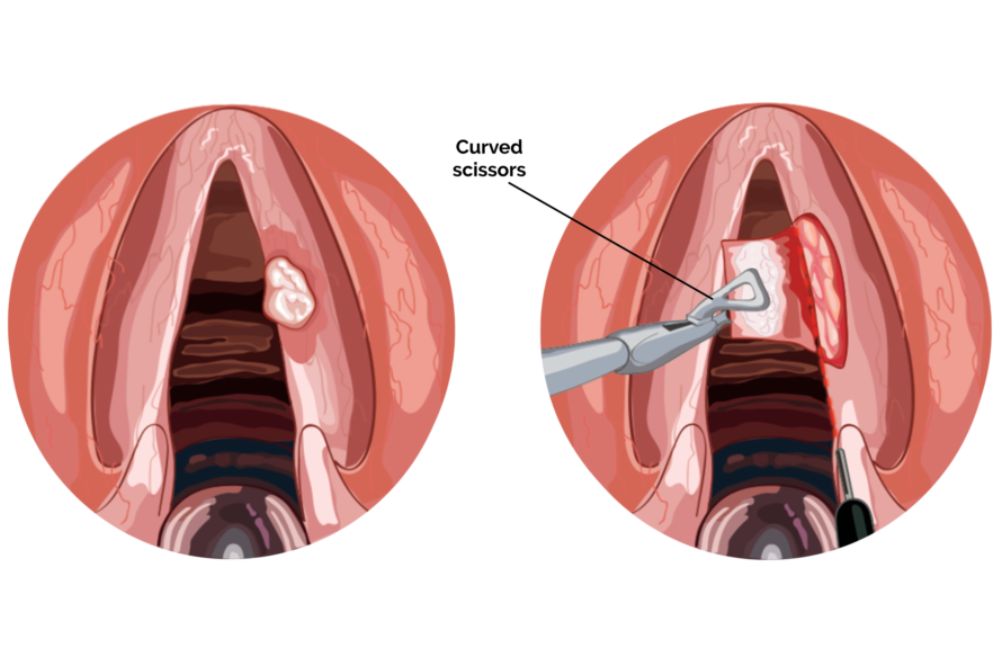 Phono Surgery